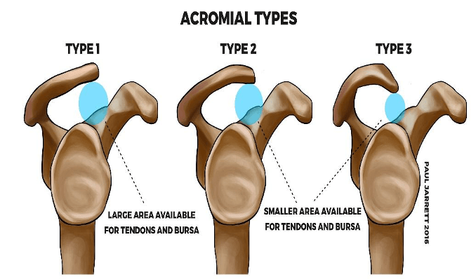 acromial types