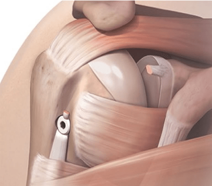 biceps tendon surgery