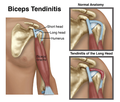 Bicep tendinitis