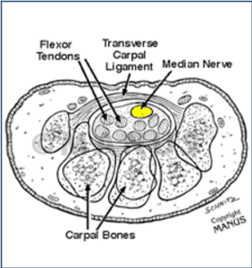 carpal tunnel syndrome