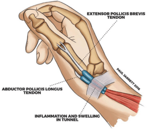 De Quervain’s Tenosynovitis