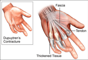 Dupuytren’s Contracture of the Hand