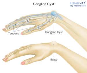 Ganglion cyst