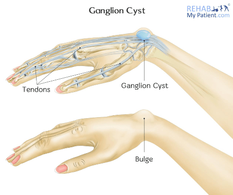 Ganglion cyst