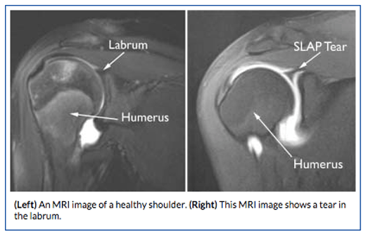 MRI of slap tear of shoulder