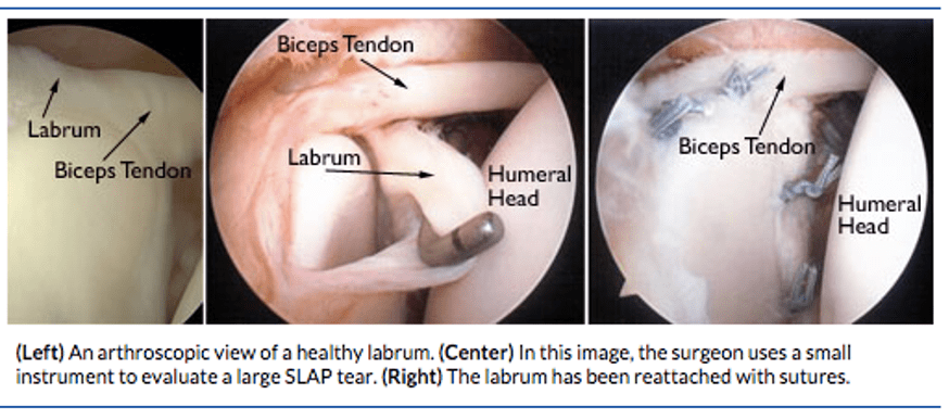 SLAP Tear surgery (Superior Labrum from Anterior to Posterior Tear)